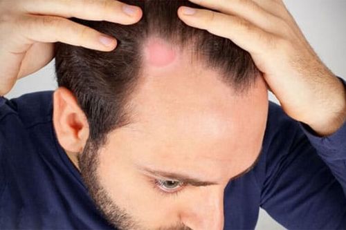 چه محصولاتی برای تمیز کردن پوست سر با خاصیت ضد قارچ و ضد باکتریال مناسب هستند؟-img